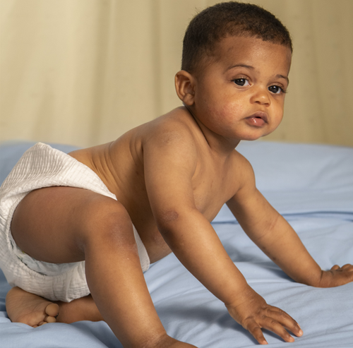 Che cos'è la dermatite atopica o eczema atopico? - Mustela Italia - 1