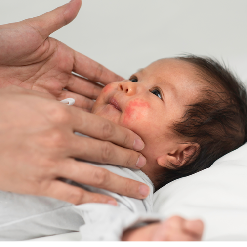 Orticaria nei bambini: cause e rimedi - Mustela Italia - 1